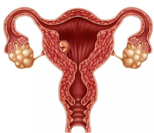 摆脱多囊卵巢综合征困扰：专家教您如何治疗